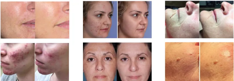 Luz facial LED infrarroja Terapia LED PDT Máquina profesional Bio Fotomodulación Luz de fototerapia LED 4