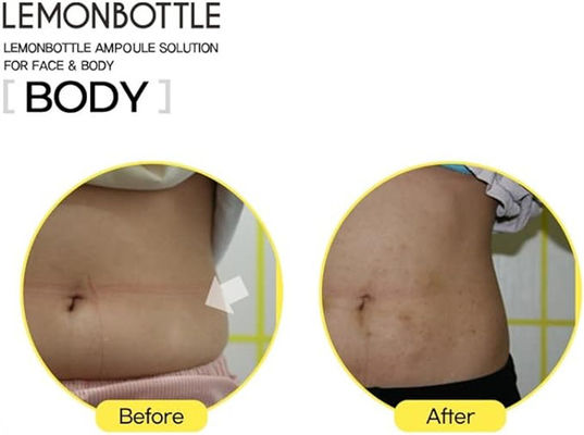 Ampola Solución de disolución de grasa inyecciones 5 viales X 10 ml botella de limón para inyecciones de pérdida de peso